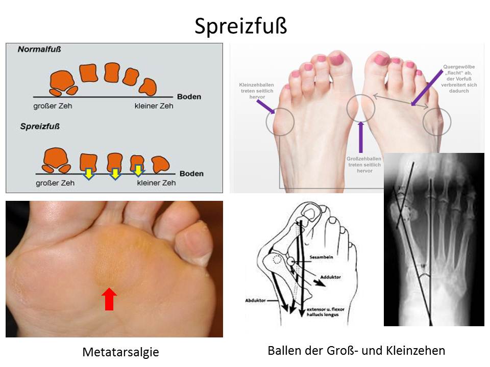 Hallux Valgus Am Kleinen Zeh
